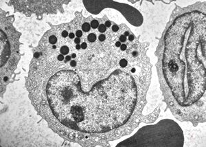 M,32y. | blood - eosinophilic leukemia M,32y. | blood - eosinophilic leukemia